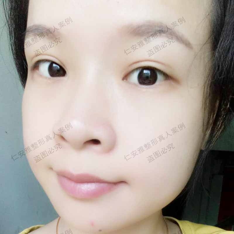 深圳割双眼皮专家有哪些？刘月更和苗春来哪位医生更厉害？