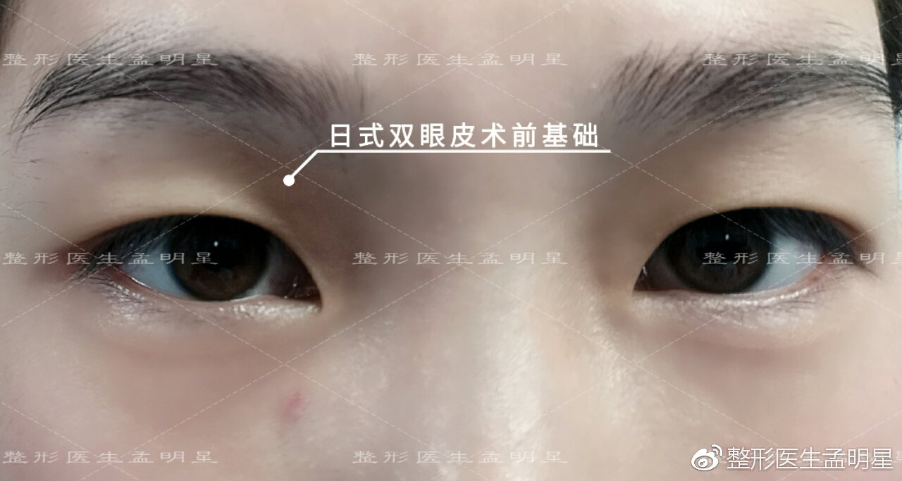 孟明星医生的日式无痕双眼皮是不是埋线双眼皮？