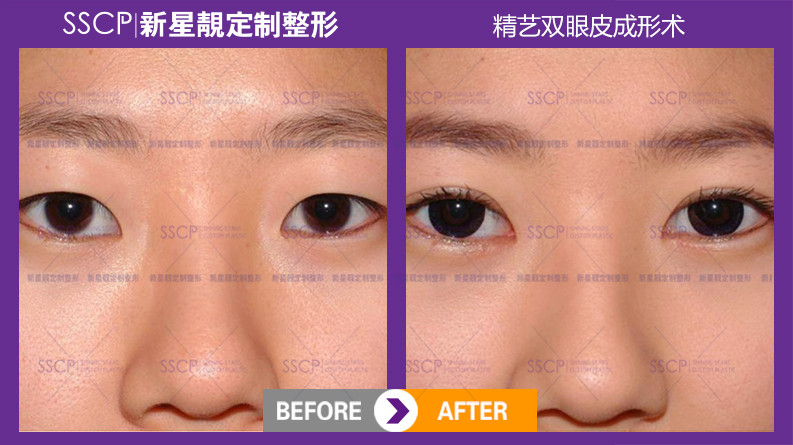 双眼皮修复专家刘风卓:刘风卓双眼皮修复案例和收费标准 双眼皮修复专家刘风卓:刘风卓双眼皮修复案例和收费标准