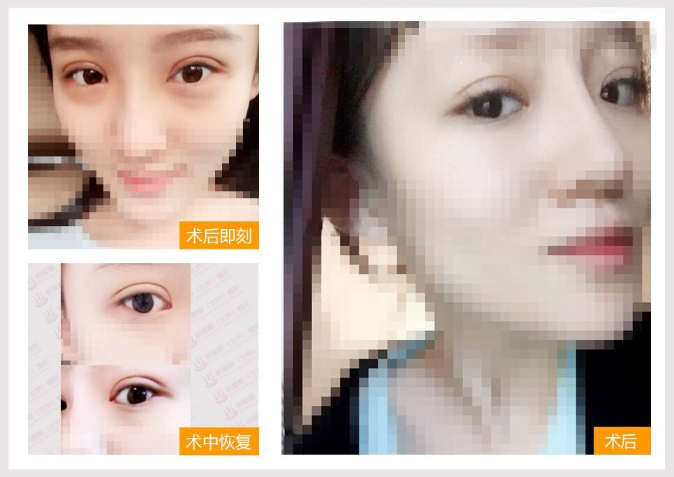 双眼皮修复专家刘风卓:刘风卓双眼皮修复案例和收费标准 双眼皮修复专家刘风卓:刘风卓双眼皮修复案例和收费标准