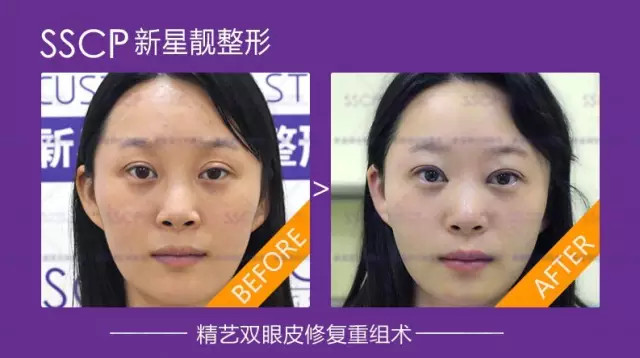 双眼皮修复专家刘风卓:刘风卓双眼皮修复案例和收费标准 双眼皮修复专家刘风卓:刘风卓双眼皮修复案例和收费标准