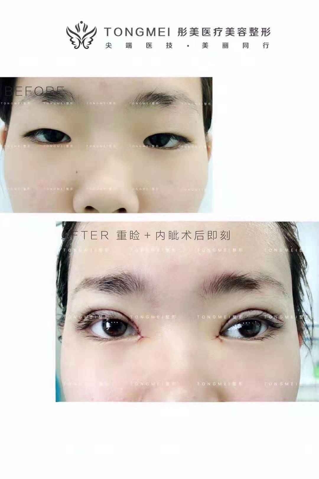 北京刘风卓割双眼皮和双眼皮修复案例效果图 刘风卓预约 北京刘风卓割双眼皮和双眼皮修复案例效果图 刘风卓预约