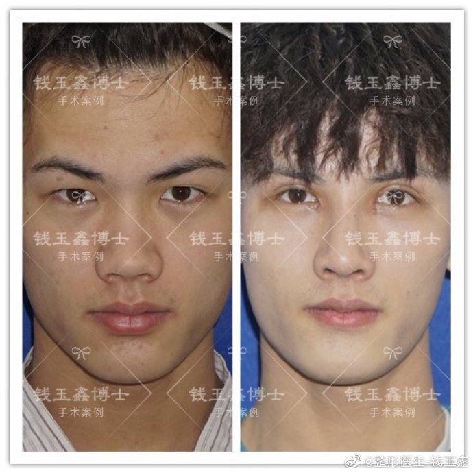 上海伊莱美钱玉鑫博士怎么样?鼻综合效果好吗?上海伊莱美钱玉鑫预约 上海伊莱美钱玉鑫博士怎么样?鼻综合效果好吗?上海伊莱美钱玉鑫预约