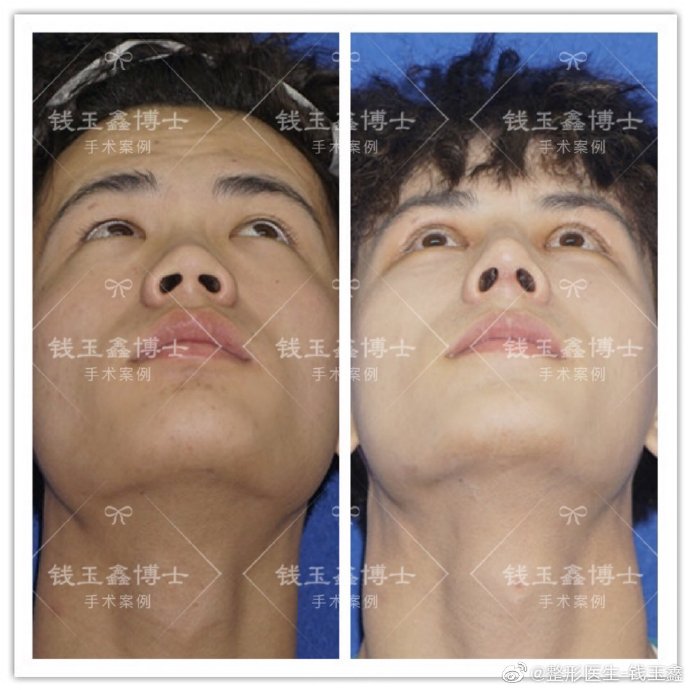 上海伊莱美钱玉鑫博士怎么样?鼻综合效果好吗?上海伊莱美钱玉鑫预约 上海伊莱美钱玉鑫博士怎么样?鼻综合效果好吗?上海伊莱美钱玉鑫预约