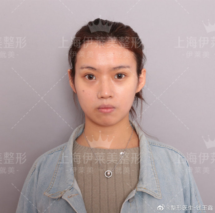 上海伊莱美钱玉鑫博士怎么样?鼻综合效果好吗?上海伊莱美钱玉鑫预约 上海伊莱美钱玉鑫博士怎么样?鼻综合效果好吗?上海伊莱美钱玉鑫预约