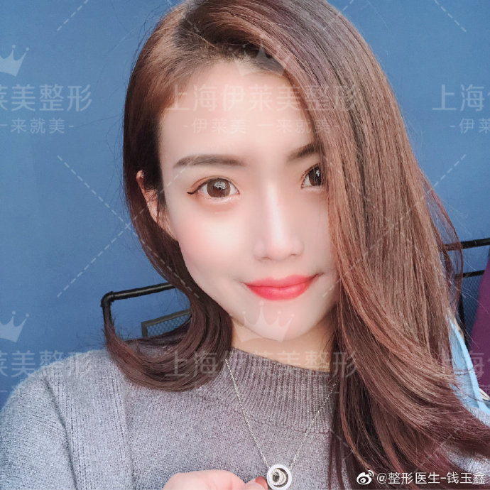 上海伊莱美钱玉鑫博士怎么样?鼻综合效果好吗?上海伊莱美钱玉鑫预约 上海伊莱美钱玉鑫博士怎么样?鼻综合效果好吗?上海伊莱美钱玉鑫预约