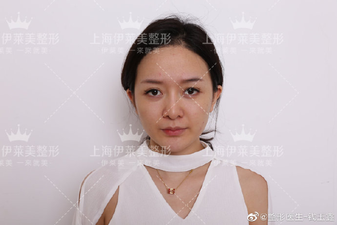 上海伊莱美钱玉鑫博士怎么样?鼻综合效果好吗?上海伊莱美钱玉鑫预约 上海伊莱美钱玉鑫博士怎么样?鼻综合效果好吗?上海伊莱美钱玉鑫预约