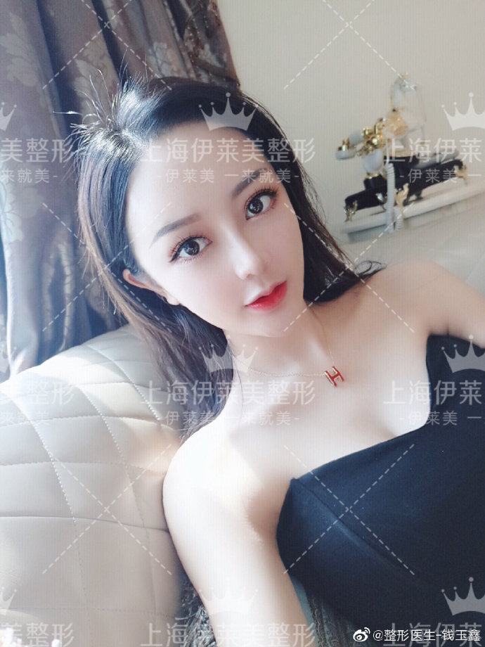 上海伊莱美钱玉鑫博士怎么样？鼻综合效果好吗？上海伊莱美钱玉鑫预约
