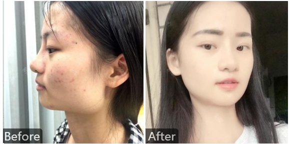 八大处整形磨骨内推多少钱？八大处整形磨骨颧骨内推最好的专家：归来、祁佐良、靳小雷、滕利预约