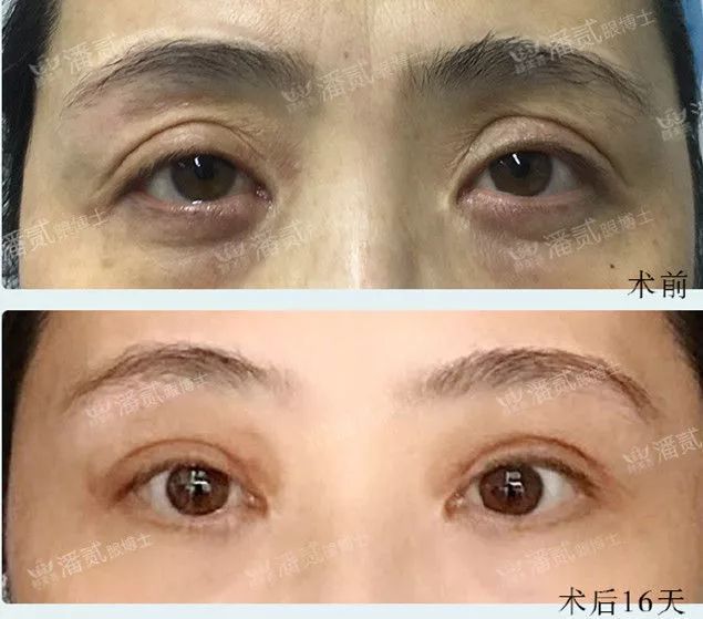 潘贰和王振军修复双眼皮谁厉害?王振军和潘贰双眼皮修复预约 潘贰和王振军修复双眼皮谁厉害?王振军和潘贰双眼皮修复预约