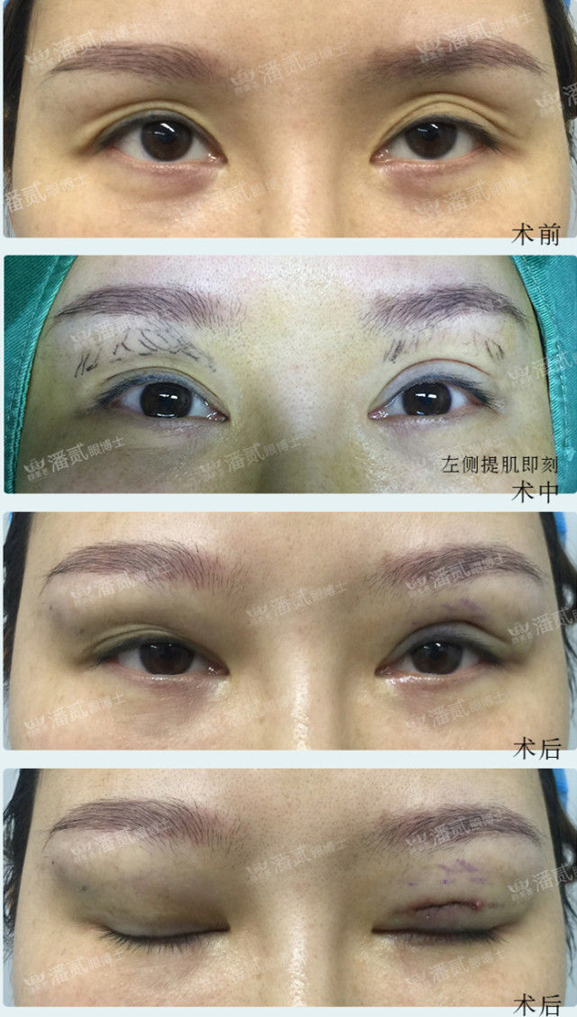 潘贰和王振军修复双眼皮谁厉害？王振军和潘贰双眼皮修复预约