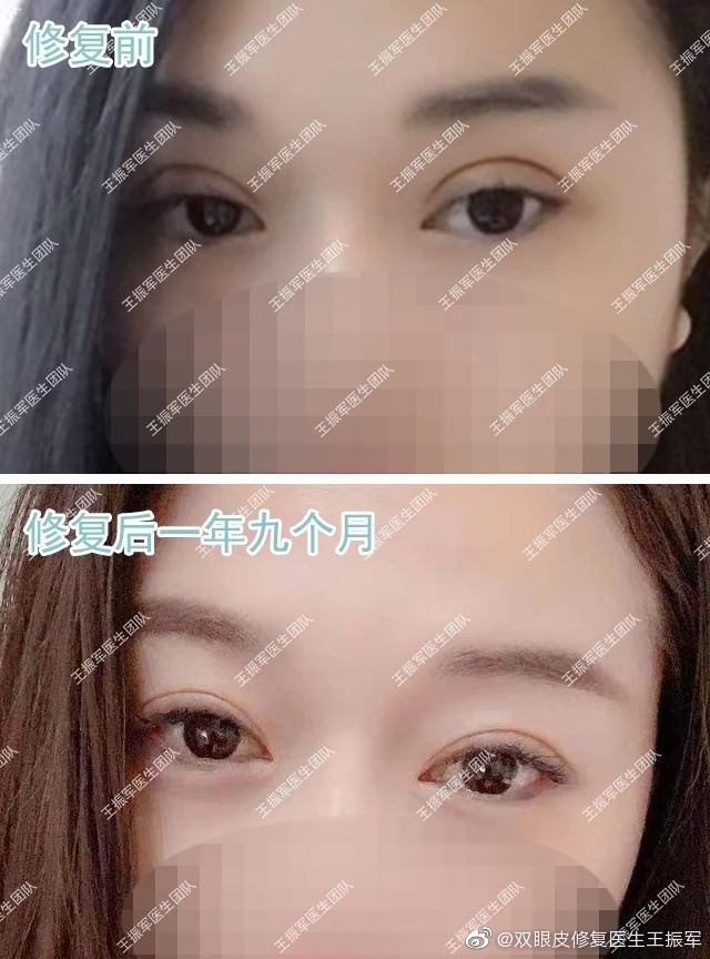 潘贰和王振军修复双眼皮谁厉害?王振军和潘贰双眼皮修复预约 潘贰和王振军修复双眼皮谁厉害?王振军和潘贰双眼皮修复预约