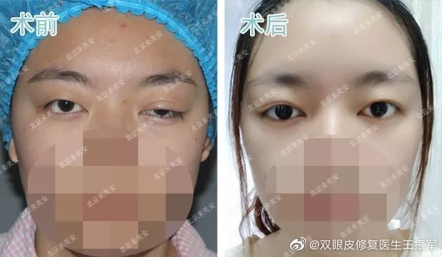 潘贰和王振军修复双眼皮谁厉害?王振军和潘贰双眼皮修复预约 潘贰和王振军修复双眼皮谁厉害?王振军和潘贰双眼皮修复预约