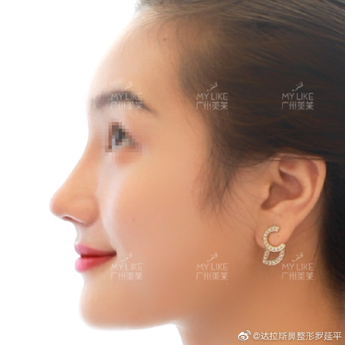 广州罗延平和欧阳春哪个隆鼻技术好?欧阳春和罗延平隆鼻&鼻修复案例预约 广州罗延平和欧阳春哪个隆鼻技术好?欧阳春和罗延平隆鼻&鼻修复案例预约