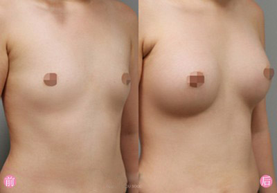 广州做丰胸最好的专家是谁？江华和王世虎哪个好？王世虎和江华案例预约