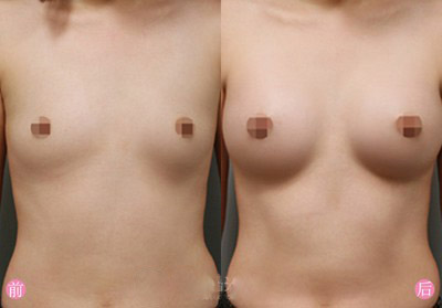 广州做丰胸最好的专家是谁？江华和王世虎哪个好？王世虎和江华案例预约