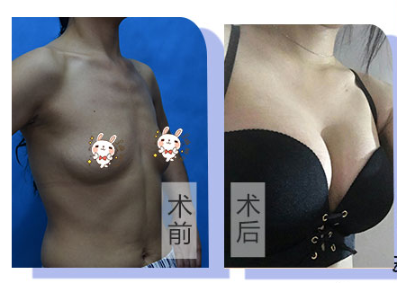 广州做丰胸最好的专家是谁？江华和王世虎哪个好？王世虎和江华案例预约