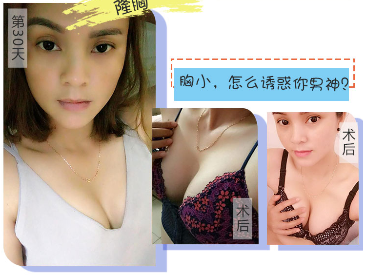 广州做丰胸最好的专家是谁？江华和王世虎哪个好？王世虎和江华案例预约