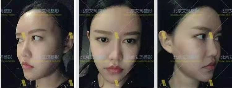 北京艾玛韦元强和上海九院曹卫刚面部脂肪修复谁好？