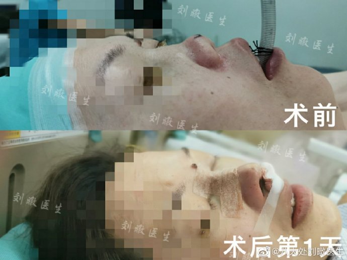 北京八大处隆鼻&鼻修复&鼻部整形最好的专家：刘暾（简介案例预约）怎么样？