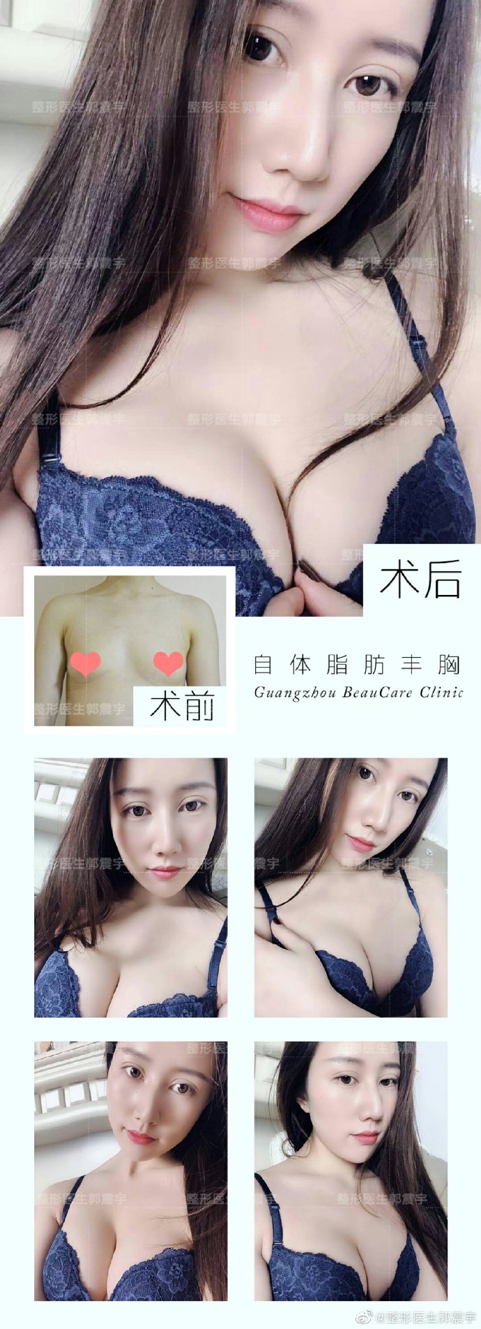 广州做自体脂肪丰胸最好的专家推荐:郭震宇医生(案例预约效果)怎么样 广州做自体脂肪丰胸最好的专家推荐:郭震宇医生(案例预约效果)怎么样