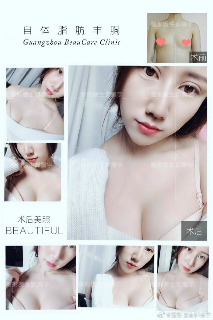 广州做自体脂肪丰胸最好的专家推荐:郭震宇医生(案例预约效果)怎么样 广州做自体脂肪丰胸最好的专家推荐:郭震宇医生(案例预约效果)怎么样