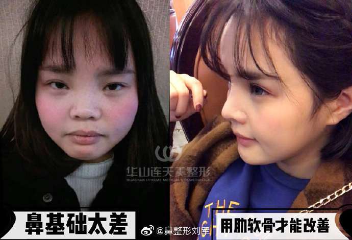 杭州华山连天美刘军医生做鼻子怎么样？有案例吗？