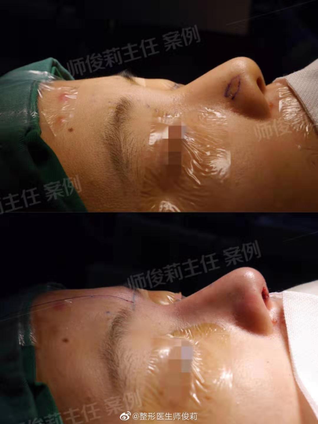 全国最好的鼻综合推荐:师俊莉(简介预约案例效果)怎么样? 全国最好的鼻综合推荐:师俊莉(简介预约案例效果)怎么样?