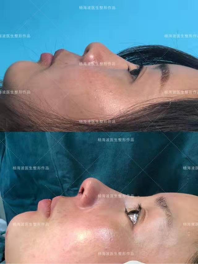 杭州做鼻子&鼻修复&鼻部整形知名专家推荐：杨海波（简介案例预约）怎么样？