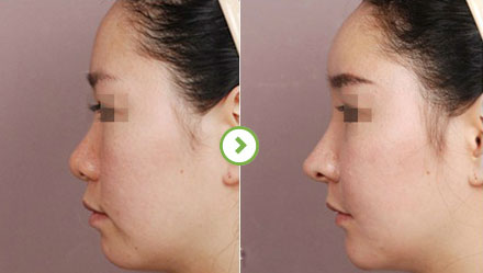 中国最厉害的鼻子&鼻修复专家（亚洲鼻王）：郑东学（案例效果预约）真的好吗