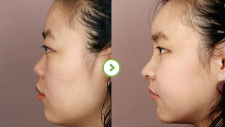 中国最厉害的鼻子&鼻修复专家（亚洲鼻王）：郑东学（案例效果预约）真的好吗