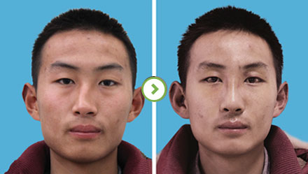 中国最厉害的鼻子&鼻修复专家（亚洲鼻王）：郑东学（案例效果预约）真的好吗