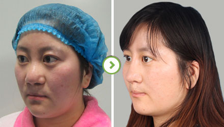 中国最厉害的鼻子&鼻修复专家（亚洲鼻王）：郑东学（案例效果预约）真的好吗