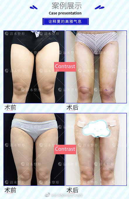 北京做大腿吸脂最好的专家推荐：马梅生（案例预约价格效果）怎么样？