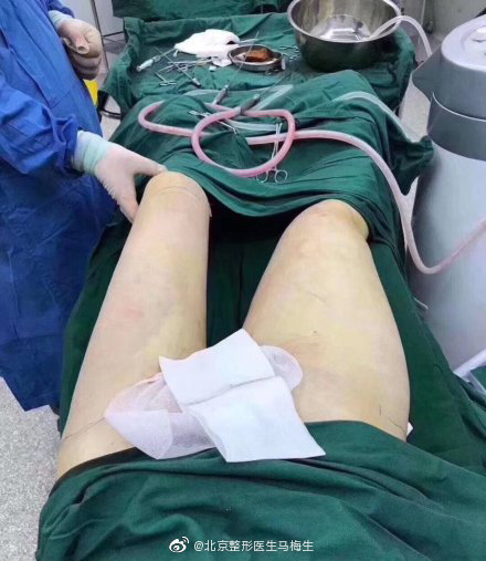 北京做大腿吸脂最好的专家推荐：马梅生（案例预约价格效果）怎么样？