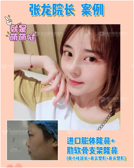 杭州肋软骨隆鼻专家推荐:格莱美张龙(效果价格预约)怎么样? 杭州肋软骨隆鼻专家推荐:格莱美张龙(效果价格预约)怎么样?