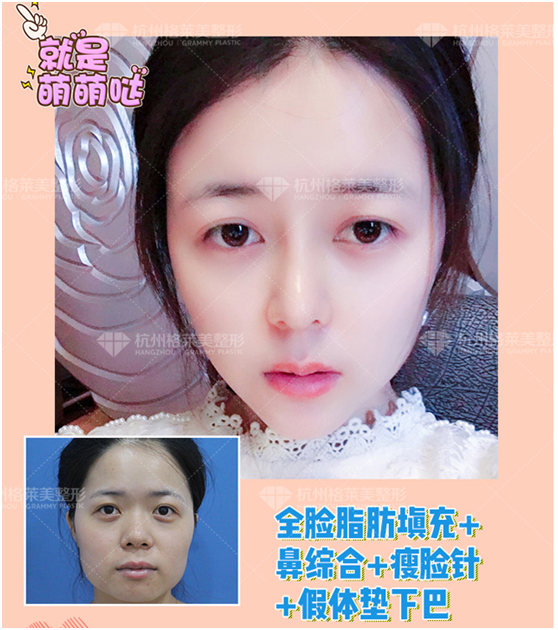 杭州肋软骨隆鼻专家推荐:格莱美张龙(效果价格预约)怎么样? 杭州肋软骨隆鼻专家推荐:格莱美张龙(效果价格预约)怎么样?