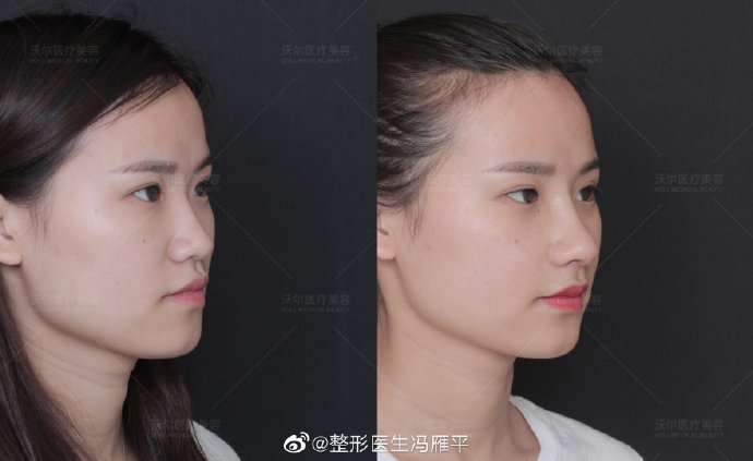 北京做鼻尖垫鼻尖最好的专家推荐：沃尔冯雁平（预约价格效果）怎么样