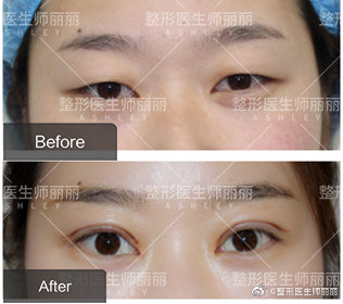 中国眼综合最知名的专家有哪些？师丽丽做眼综合效果好吗？