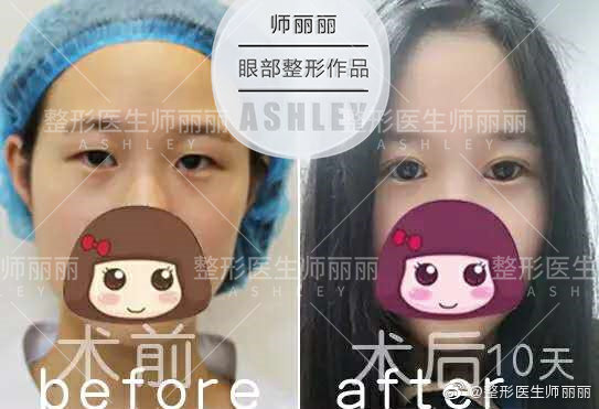 中国眼综合最知名的专家有哪些？师丽丽做眼综合效果好吗？