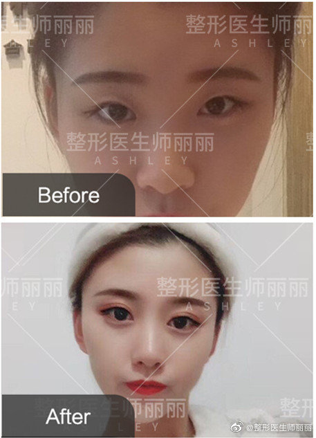 中国眼综合最知名的专家有哪些？师丽丽做眼综合效果好吗？