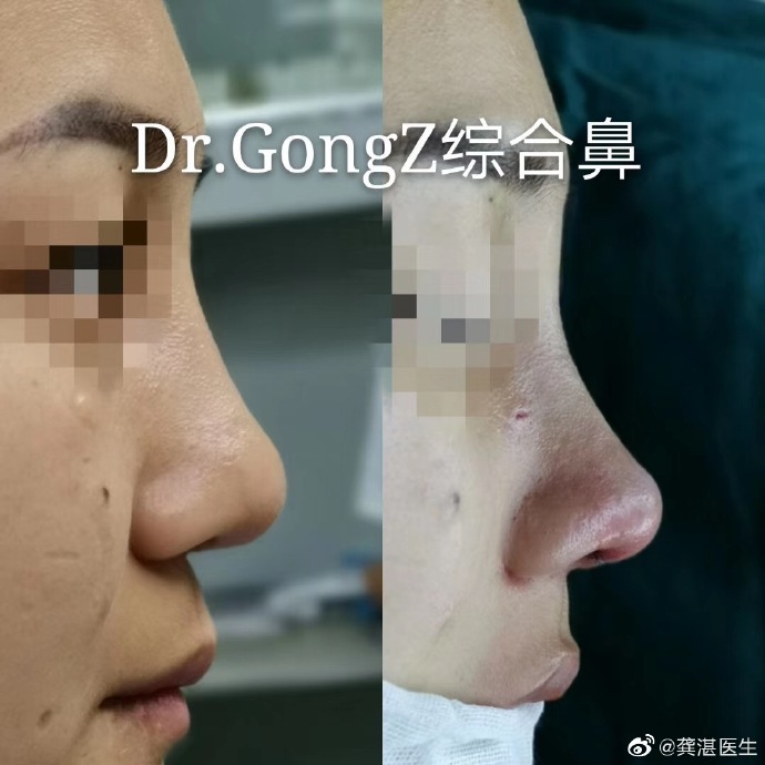 广州做鼻子&网红鼻&鼻修复知名专家推荐:龚湛(案例效果预约)怎么样? 广州做鼻子&网红鼻&鼻修复知名专家推荐:龚湛(案例效果预约)怎么样?