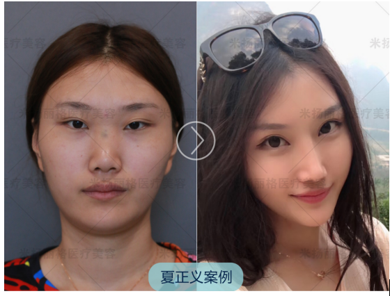 北京鼻部整形&鼻修复整形专家推荐:夏正义(案例效果价格预约)怎么样? 北京鼻部整形&鼻修复整形专家推荐:夏正义(案例效果价格预约)怎么样?