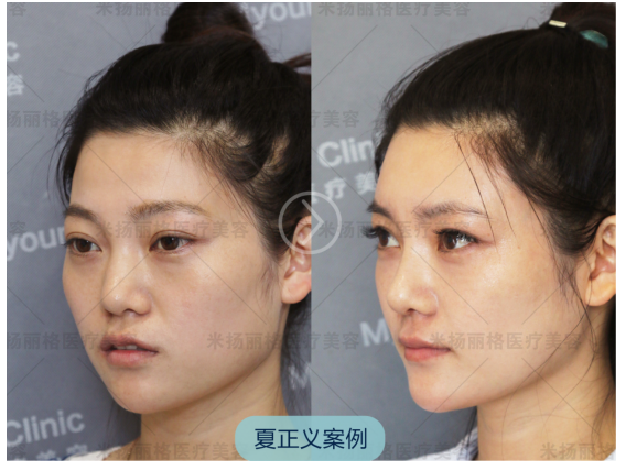 北京鼻部整形&鼻修复整形专家推荐:夏正义(案例效果价格预约)怎么样? 北京鼻部整形&鼻修复整形专家推荐:夏正义(案例效果价格预约)怎么样?