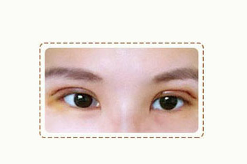 别让眼部问题影响了你的一生_深圳恩吉娜双眼皮修复