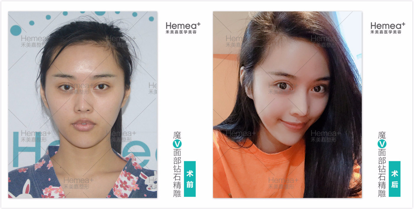 任学会和王凤芹哪个做面部脂肪填充好? 任学会和王凤芹哪个做面部脂肪填充好?