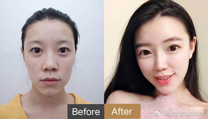 任学会和王凤芹哪个做面部脂肪填充好? 任学会和王凤芹哪个做面部脂肪填充好?
