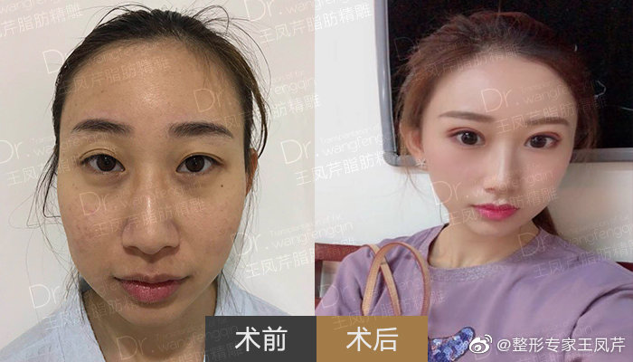 任学会和王凤芹哪个做面部脂肪填充好? 任学会和王凤芹哪个做面部脂肪填充好?