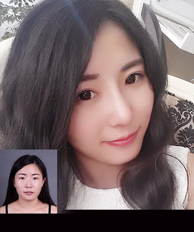 中国最好的鼻整形专家：曹海峰和李信峰（案例预约）综合隆鼻哪个好？