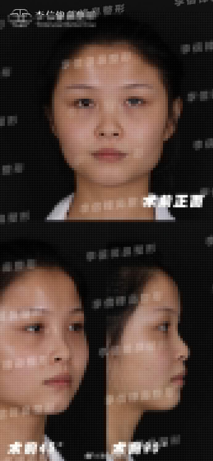 中国最好的鼻整形专家：曹海峰和李信峰（案例预约）综合隆鼻哪个好？